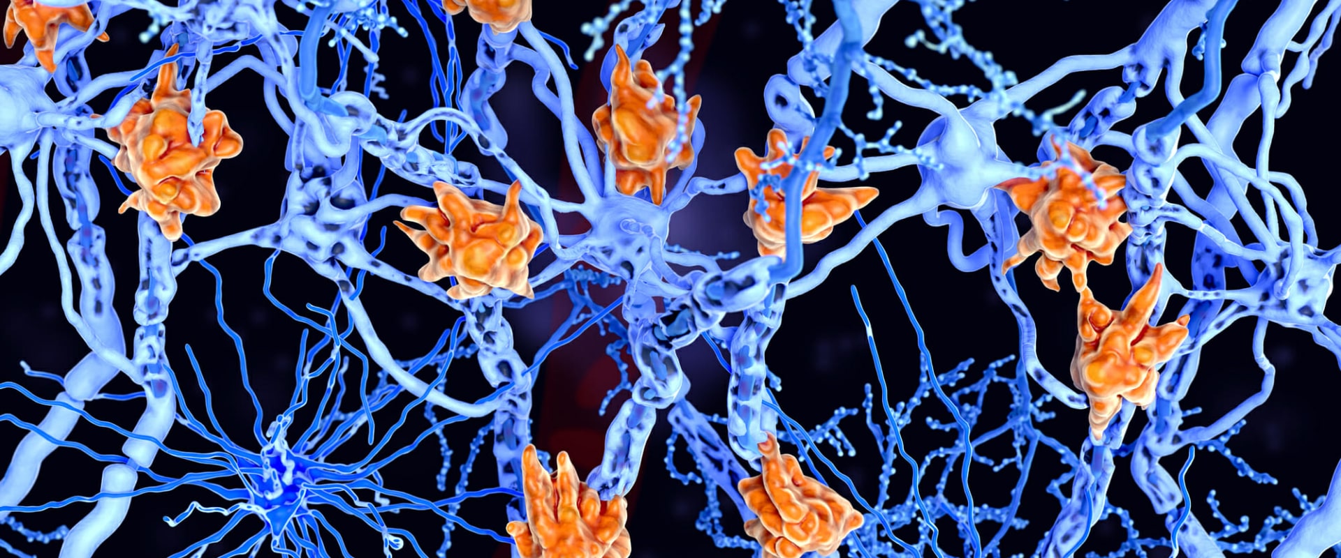 how-do-the-symptoms-of-ms-relate-to-demyelinated-neurons